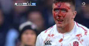 Rent blodbad: Engelsk rugbystjerne kom på banen igen efter dette